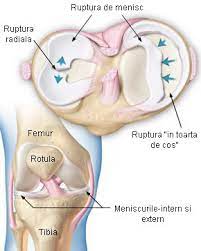 Ruptura de menisc poate determina blocarea articulatiei genunchiului, singurul moment in care acesta leziune este o urgenta chirurgicala. Ruptura De Menisc Ortopedia Pe InÅ£elesul Tuturor