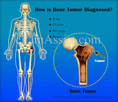 Around 550 new cases are diagnosed each year in the uk. Bone Tumor Types Symptoms Treatment Survival Period