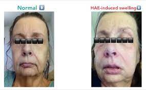 Pin On Hereditary Angioedema Hae