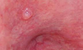 There are a number of reasons which cause bumps in your mouth. Bump On Roof Of Mouth Small Hard Painful White Red Lump On Palate Behind Front Teeth