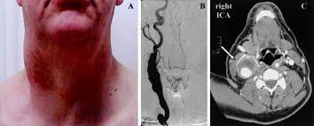 These two blood vessels extend through each side of the neck. A Swelling Of The Right Neck And Sudden Death Circulation