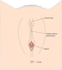 Image result for Labial Fusion