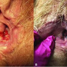 Image result for Vulvitis