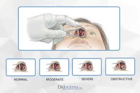 Nasal polyps are small, noncancerous growths that line your nasal passages or sinuses. Nasal Polyps Symptoms Causes And Natural Support Strategies