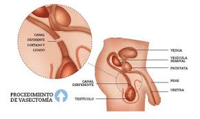 A vasectomia é um procedimento muito simples e eficaz. Vasectomia Que Puedo Esperar Centro Andrologico