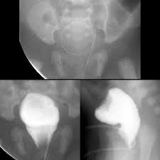 Image result for Voiding Cystourethrogram