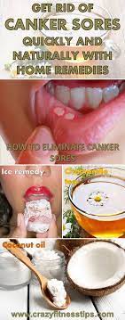 Get Rid Of Canker Sores Quickly And Naturally With Home Remedies Canker Sore Healthy Blogs Cankers