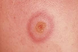 Image result for Erythema Multiforme Causes