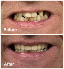Everything You Need To Know About Dentures In Ottawa