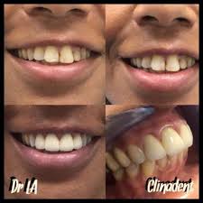 Realisation De Couronnes Et Facettes Tout Ceramique Dans Les Centres Dentaires Clinadent Courbevoie Becon 92400 Centre Dentaire Courbevoie Becon