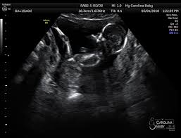 Ultrasound Services In Charlotte Nc My Carolina Baby
