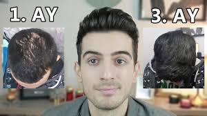 Doktor Genetik Sac Dokulmesi Var Dedi 2 Ayda Saclarimi Nasil Iyilestirdim Aras Barlas Youtube