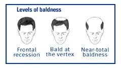 Hair loss can have many causes. Hereditary Patterned Baldness Guide Causes Symptoms And Treatment Options