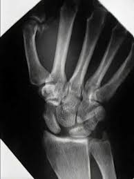 Image result for Scaphoid Shift Test