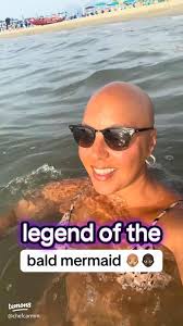 Embracing Baldness: My Journey with Alopecia