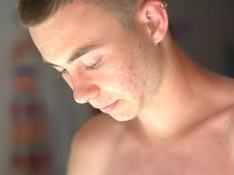 Up to 2 weeks of downtime: Retin A For Acne Uses Side Effects And More