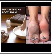 Soak nightly, then moisturize your feet and put on socks. Listerine Foot Soak Perfect For Dry Cracked Feet Foot Soak Listerine Foot Soak Listerine
