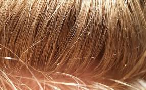 Fleas can attack humans and can carry some nasty bugs. Can Fleas Live In Human Hair Pestseek