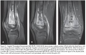 Image result for Osteomyelitis XRay