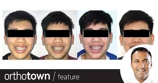 Success! Canted Smile Corrected - Youtube
