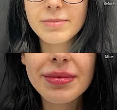 Improve Lip Shape: Enhancing Symmetry and Fullness
