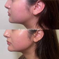 Stephanie Lemmon MS, PAC (@injections.by.steph) • Instagram photos and  videos