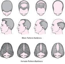 Quick Facts Hair Loss Merck Manuals Consumer Version