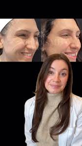 All about #psoriasis with Bianca Patel, PA-C✨ Schedule a consultation with  Dr. Nichols and our team of board-certified providers through the link in  our bio today for a comprehensive consultation and treatment