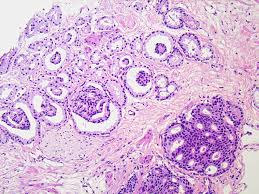 This review focuses on histopathological aspects of carcinoma of the prostate. A Contemporary Update On Pathology Reporting For Prostate Cancer Biopsy And Radical Prostatectomy Specimens European Urology