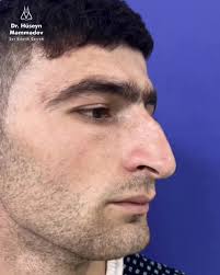 Rinoplastika əməliyyatından öncə və 4 ay sonrakı nəticə 🇦🇿✓ #drhusey...