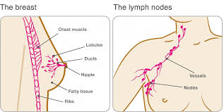 It is the second most common cause of. Primary Breast Cancer Breast Cancer Now