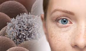 If you know what to look for, you can spot warning signs of skin cancer early. Skin Cancer When Your Freckles Could Be A Sign Of The Deadly Condition Express Co Uk