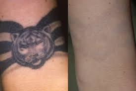 Laser tattoo removal costs just $200 per treatment at go! Laser Tattoo Removal Virginia Beach David H Mcdaniel Md Laser Center And Medical Spadavid H Mcdaniel Md Laser Center And Medical Spa