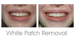 Clean your clear braces by brushing your teeth more often than usual 1. White Marks On Teeth How To Remove Them Price Review Pictures