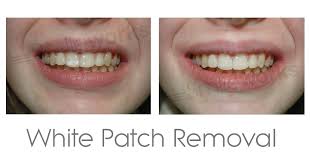 Such spots on your teeth can lower down your confidence and make you may hesitate while opening your mouth. White Marks On Teeth How To Remove Them Price Review Pictures