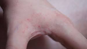 Image result for bedbugs bites