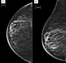 Ct scans can detect bone and joint problems, like complex bone fractures and tumors. Cureus Hematoma Mimicking Breast Cancer On Ct Scan And Breast Ultrasound