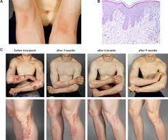 • tell me about your eczema? Clinical And Immunopathologic Findings During Treatment Of Recalcitrant Atopic Eczema With Efalizumab Journal Of The American Academy Of Dermatology