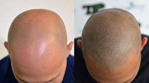 La micropigmentazione consente anche il camuffamento delle cicatrici. Tricopigmentazione Del Cuoio Capelluto Cos E Quanto Costa Come Funziona Ricrescitacapelli24 Com