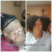 Crochet Braids On Thinning And Balding Hair Alopecia Hairstyles Alopecia Natural Hair Thick Hair Remedies