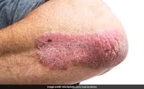 We may earn commission from links on this page, but we only recommend products we back. Difference Between Psoriasis And Skin Cancer Symptoms And Risk Factors
