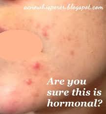 The rash may spread up to the nose or even the eyes. Pin On Rosacea Solutions