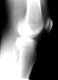 Image result for Segond Fracture