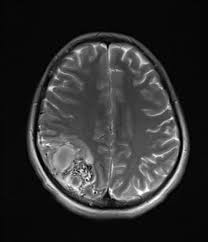 Cerebral Arteriovenous Malformation Radiology Case Radiopaedia Org Radiology Radiology Imaging Neurology