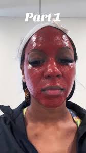 First ever chemical peel! #atlanta #charrettecosmetics #chemicalpeel