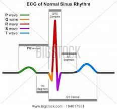 Ecg Normal Sinus Image Photo Free Trial Bigstock