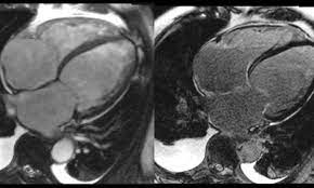Journal of the american college of cardiology vol. Kardiale Mrt Messen Statt Sehen