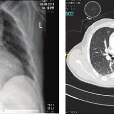 Hemothorax and tension pneumothorax will both present with chest pain and cxr: A Chest Radiograph And B Corresponding Ct Scan Of Patient With 24 Download Scientific Diagram
