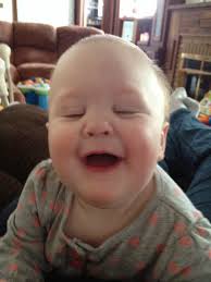 Renae's journey with Trigonocephaly Metopic Craniosynostosis.