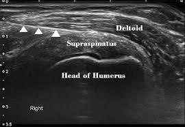 Image result for Subacromial Space Injection